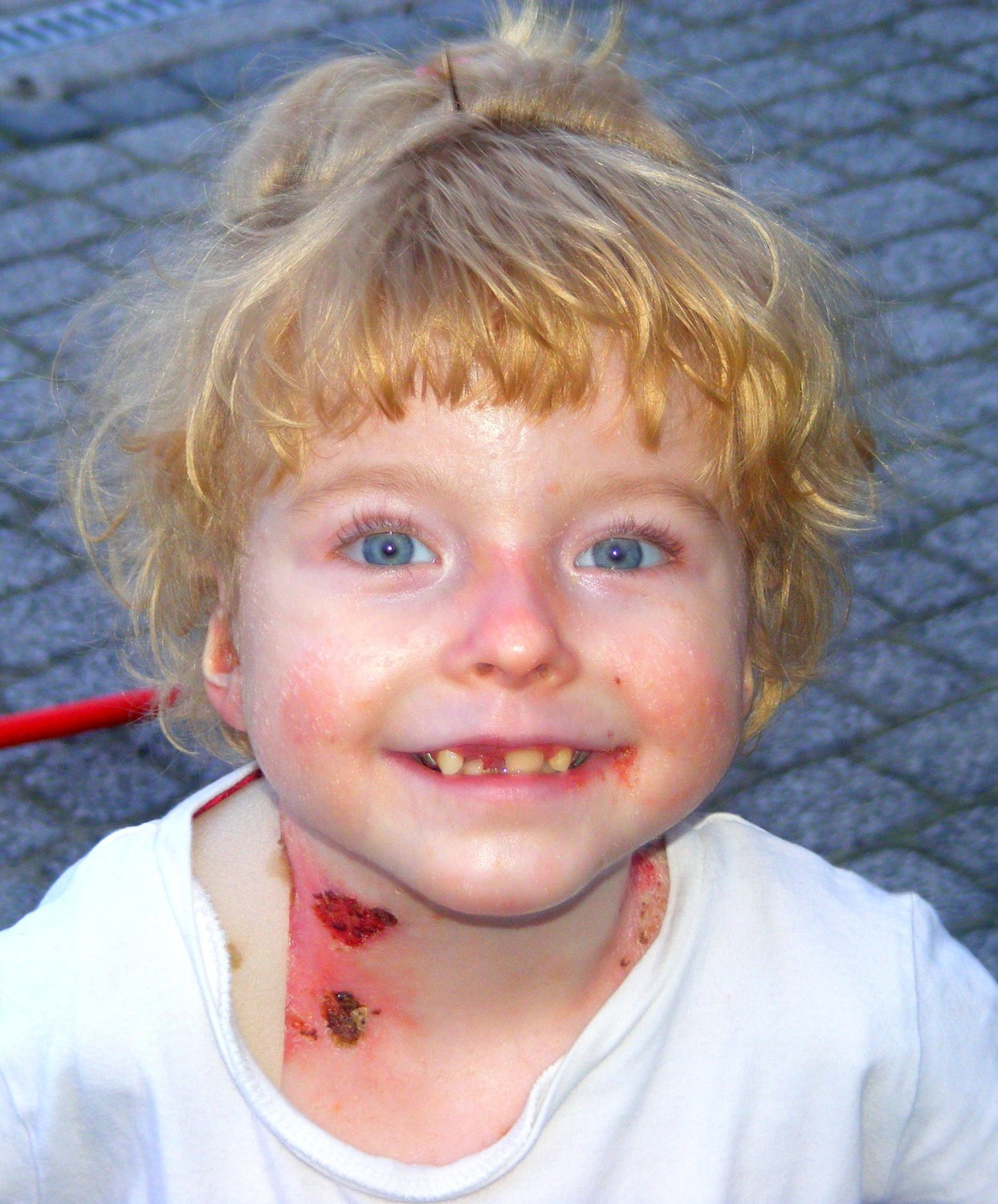 Zuzia Macheta cierpi na Epidermolysis Bullosa. Potrzeba pięciu milionów złotych na leczenie dziewczynki