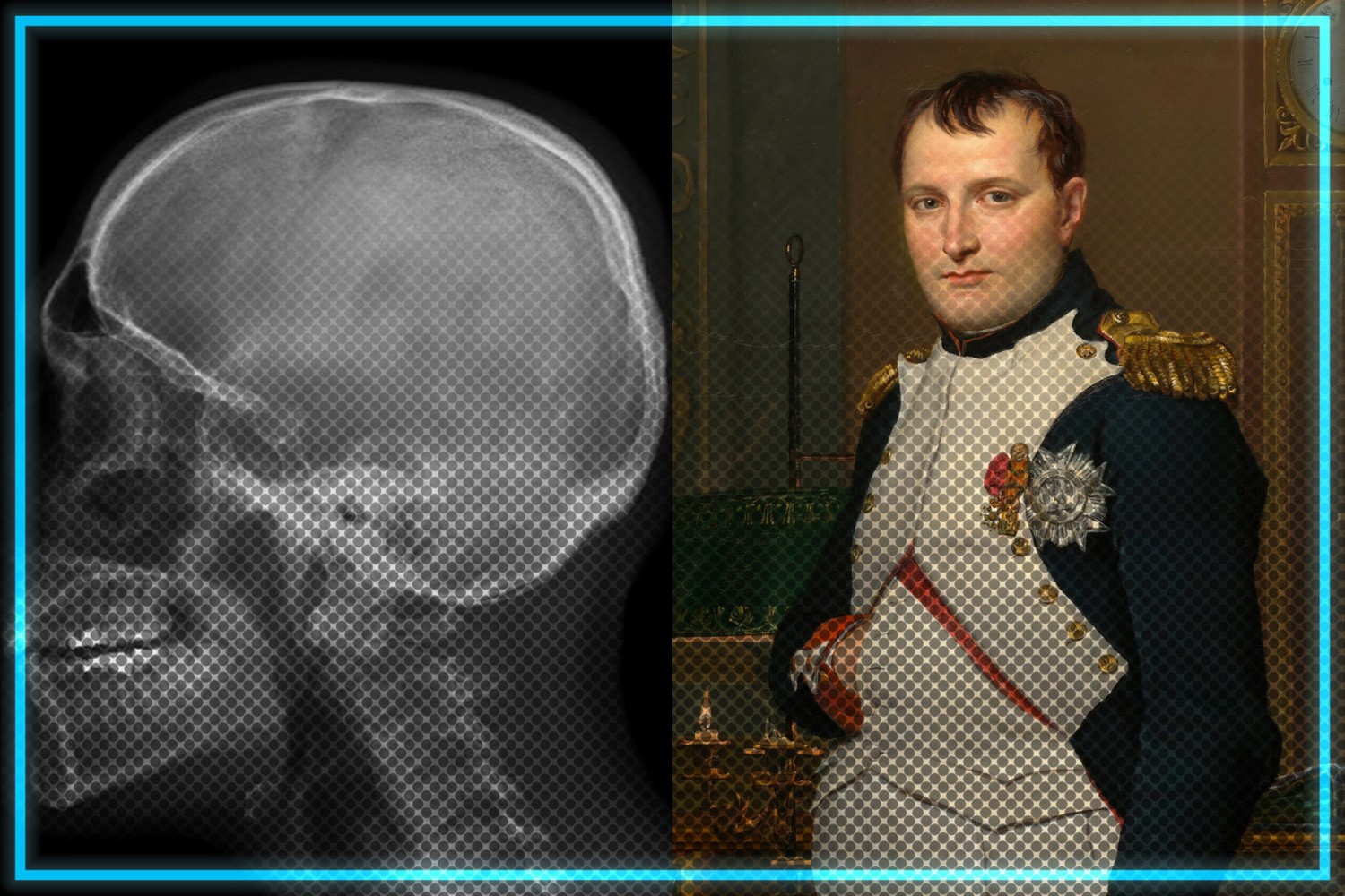 Naukowcy odkryli w czaszce Napoleona Bonaparte obiekt o średnicy 0,5 cala