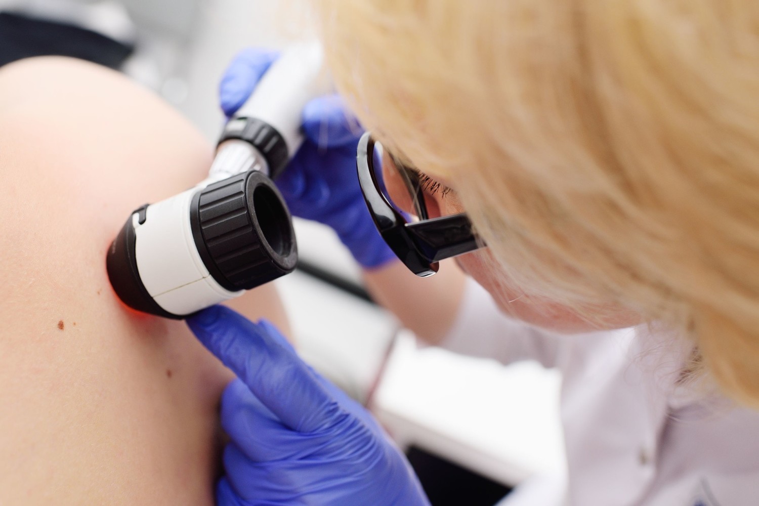 Badanie z użyciem dermatoskopu pozwala lekarzowi dokładnie przyjrzeć się zmianon skórnym i jest zalecane w ramach profilaktyki raka skóry