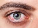 Ten objaw Omikronu widać w oczach! Może on być jedynym symptomem zakażenia koronawirusem. Zobacz, jak go rozpoznać