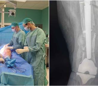 Skomplikowana operacja w szpitalu Szczeklika uratowała pacjentkę przed kalectwem